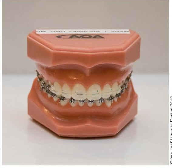 Ceramic (Clear) Braces (Upper) with Stainless Steel Braces (Lower)