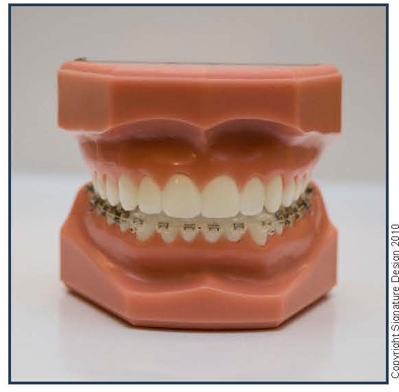 Lingual (Invisible) Upper Braces with Clear Composite Lower Braces