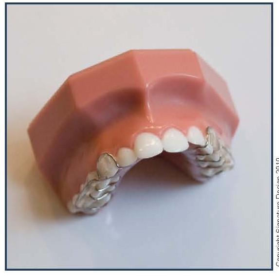 Removable Palatal Expansion Appliance (KDE)